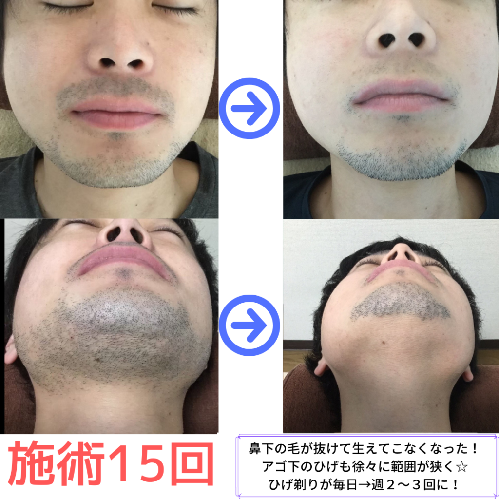 スタッフ　ヒゲ脱毛１５回